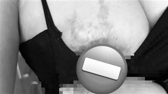 罹蟹足腫控「隆乳害潰爛」診所：不符事實