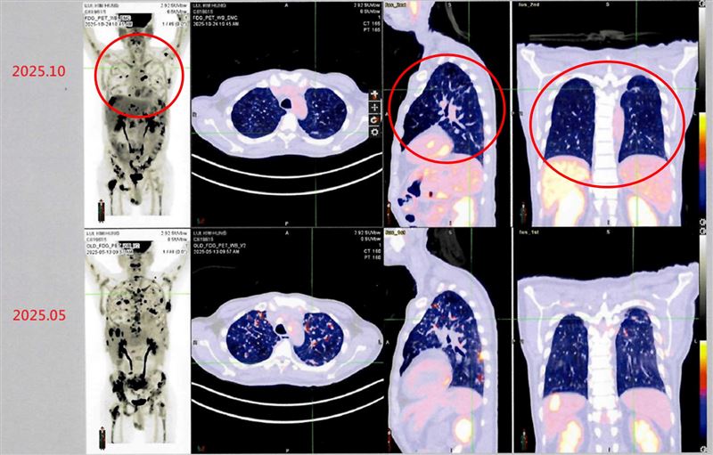 香港患者確診肺癌第四期，來台接受自體免疫細胞治療後，從治療前後影像資料對比（紅圈處），可發現癌細胞減少許多，顯示病情穩定。（圖／衛生福利部雙和醫院提供）