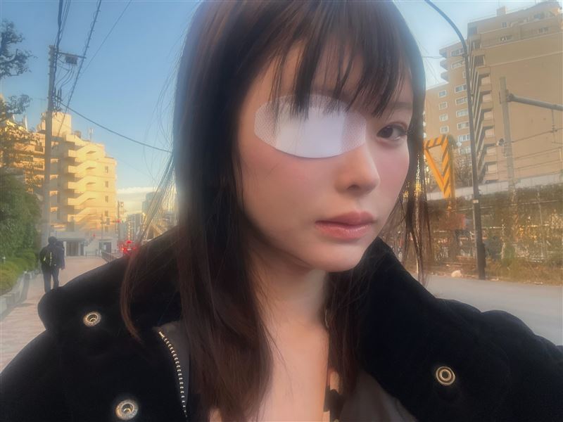 松本麗鈴接受媒體採訪成了獨眼龍，她透露是被前男友毆打受傷，而且不是第一次被家暴了。（圖/翻攝自松本麗鈴X）