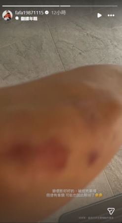 豆花妹17日突然曬出一張受傷照。（圖／翻攝自IG）