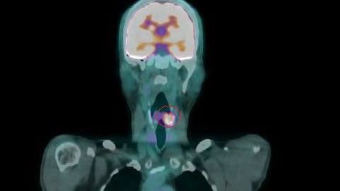 正子攝影顯示下咽癌(紅圈處)。(圖/衛福部彰化醫院提供)