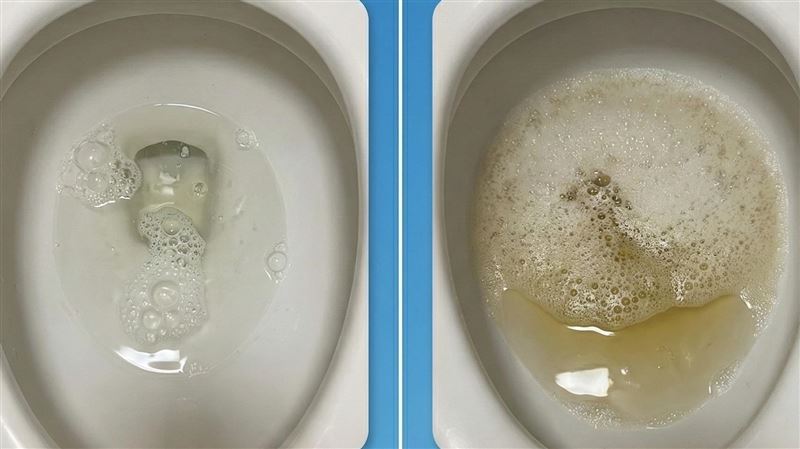 一早尿尿都是泡！醫曝「2警訊」恐是腎病