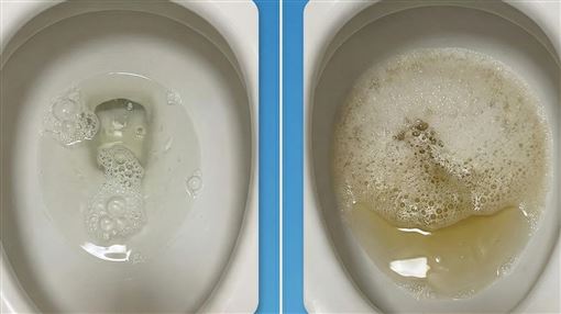 一早尿尿都是泡！醫曝「2警訊」恐是腎病