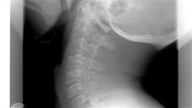 頸椎,X光。（示意圖／PIXABAY）