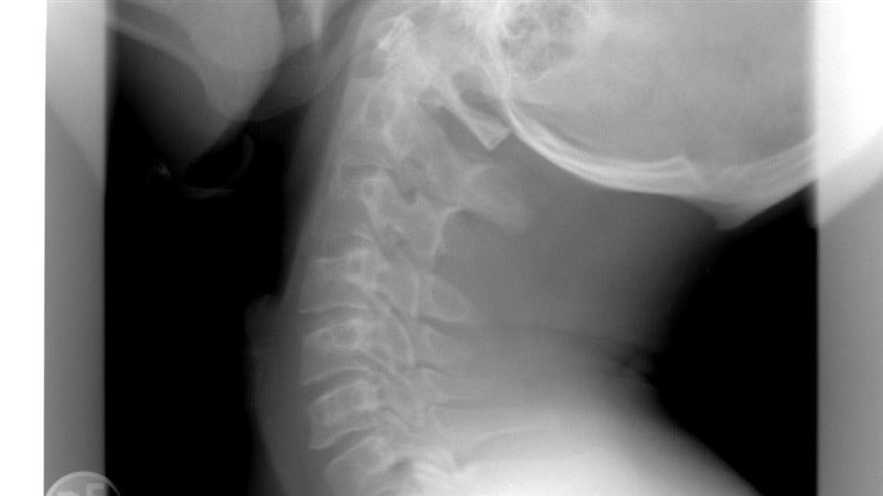 6旬翁「頭頸分離」命危!醫1招奇蹟保命