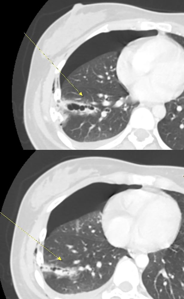23歲女子出車禍，胸腔受到劇烈撞擊，導致肋骨斷裂刺破肺臟。（圖／澄清醫院提供）
