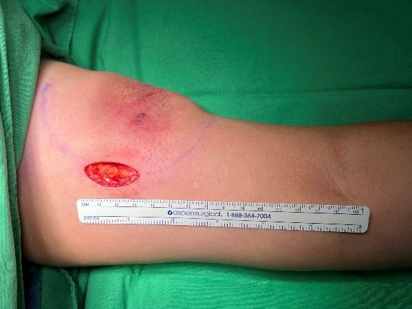 隨著微創手術進步，只需3公分細小切口，就能精準分離並完整取出直徑約10公分的巨大脂肪瘤。（圖／亞大附醫提供）