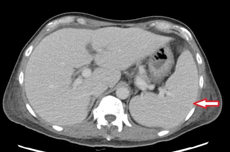 電腦斷層發現個案脾臟腫大。（圖／台北慈濟醫院提供）