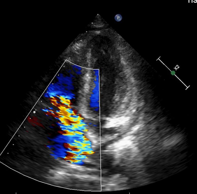 影像檢查發現三尖瓣逆流。（圖／台北慈濟醫院提供）