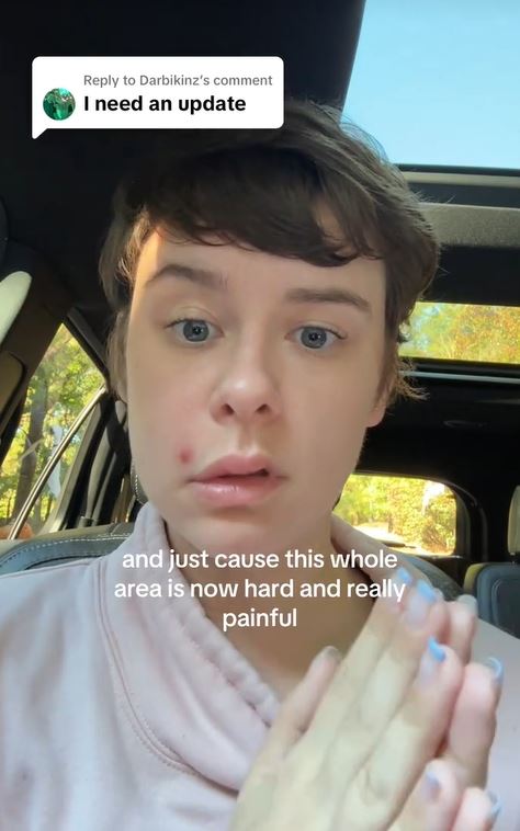 琳賽（Lindsay deOliveira）擠破痘痘引發嚴重感染，甚至半臉出現癱瘓症狀。（圖／翻攝自TikTok @neverdulldeos1）