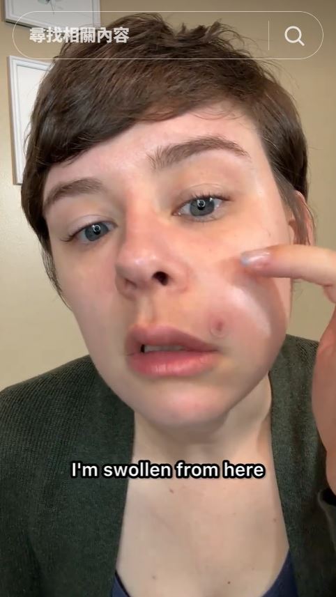 女網紅琳賽（Lindsay deOliveira）擠破痘痘竟引發嚴重感染。（圖／翻攝自TikTok @neverdulldeos1）