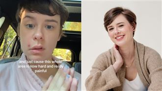 擠一顆痘竟半臉癱瘓　他親揭：死亡三角區