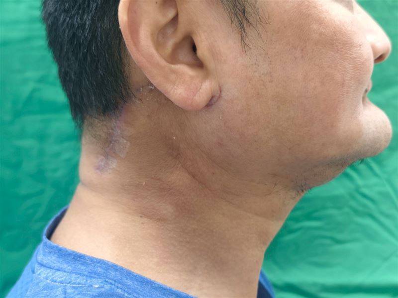 患者藉由達文西機械手臂進行口腔癌淋巴廓清術，位置隱藏於耳後，不影響外觀。（圖／雙和醫院提供）