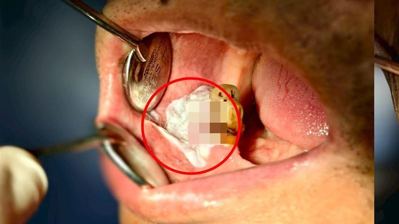 他「臉腫以為牙周病」竟癌症 3警訊快就醫