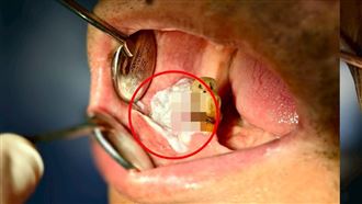 左側紅圈處為口腔癌細胞患處，經手術治療後，陳男口腔內並無復發跡象。（圖／雙和醫院提供）