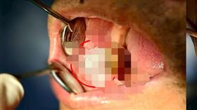 左側紅圈處為口腔癌細胞患處，經手術治療後，陳男口腔內並無復發跡象。（圖／雙和醫院提供）