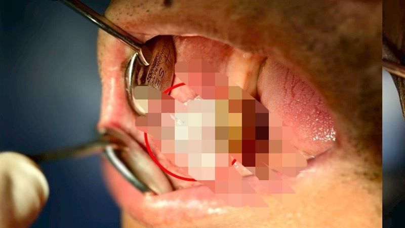 他「臉腫以為牙周病」竟癌症 3警訊快就醫