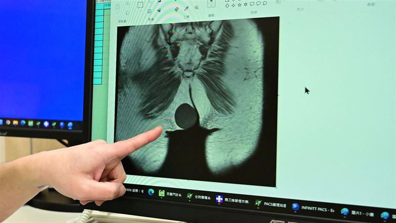 抱孩子真能練出「巨大」二頭肌？一名三寶媽愈看愈不對勁，就醫發現竟然是....（圖／亞大附醫提供）