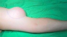 脂肪瘤,手臂,兩倍大,三寶媽,台中,開刀,微創,不留疤,亞大附醫（圖／亞大附醫提供）