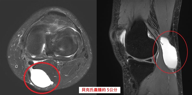 女子診斷為「貝克氏囊腫」膕窩囊腫約5公分。（圖／中國醫藥大學新竹附設醫院提供）