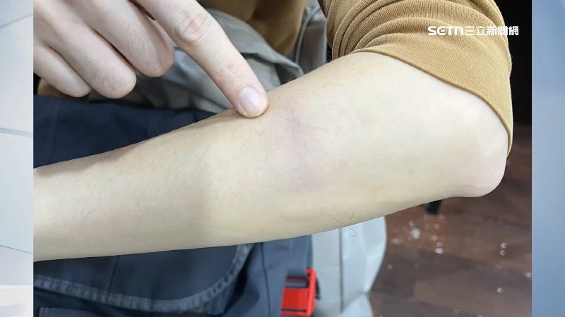 被攻擊男子手部多處瘀青