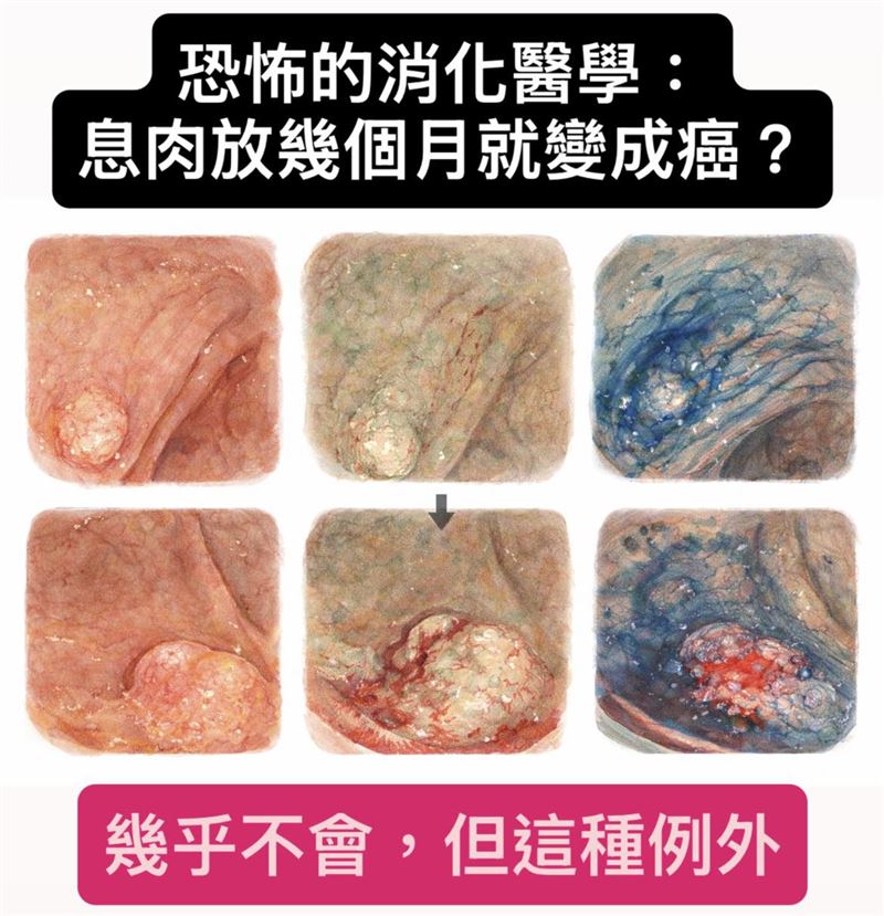 「大腸鋸齒狀腺瘤」很容易被忽略，潛伏期可達20年，一旦出現「化生不良（異型增生）」，會在短短幾個月內迅速轉化為大腸癌。（圖／翻攝自葉人豪醫師 Dr.Y臉書）