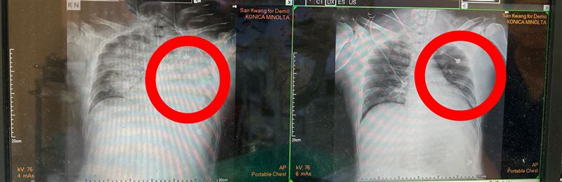 男子喝珍奶嗆咳後昏迷，送醫時雙側肺部出現大片浸潤影，處於嚴重缺氧狀態。（圖／豐原醫院提供）