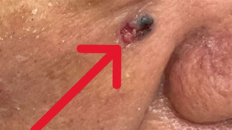 臉上長痣竟是癌症　醫：出現1現象快就醫