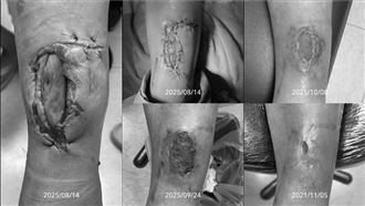 深層創傷,自癒,治療,外傷