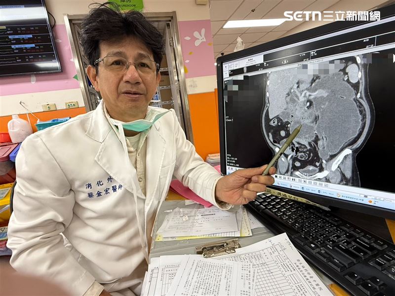 52歲川菜主廚因劇烈腹痛休克送醫，檢查發現竟是胰臟炎併發十二指腸穿孔，致死率高達40％。（圖／台中醫院提供）
