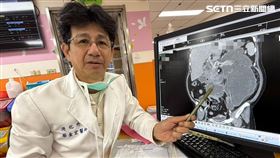 胰臟炎,併發症,十二指腸,腸穿孔,腹膜炎,鬼門關,台中,命危,休克（圖／台中醫院提供）