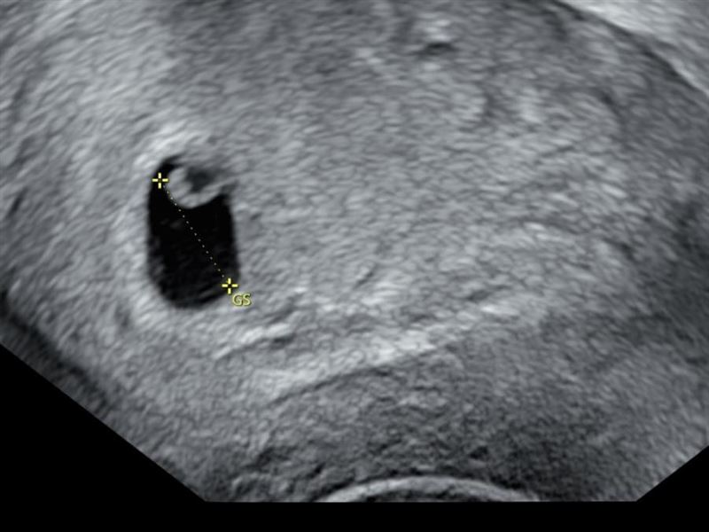 雞排妹(鄭家純)今發文表示流產。(圖/翻攝自鄭家純臉書)