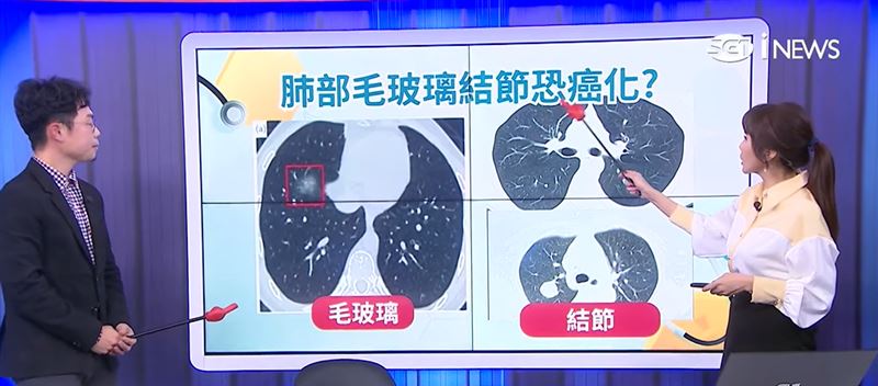 胡瓜肺部驚現「毛玻璃」，一度擔心肺癌。振興醫院胸腔內科醫師曾敬閔提醒，可從手指觀察肺部健康，一旦出現長期咳嗽、胸悶，應及早做檢查。（圖／翻攝自《健康e起聊》）