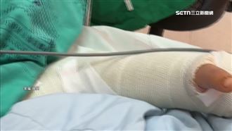 獨／兒玩夜市充氣床「摔斷手開刀」母自責
