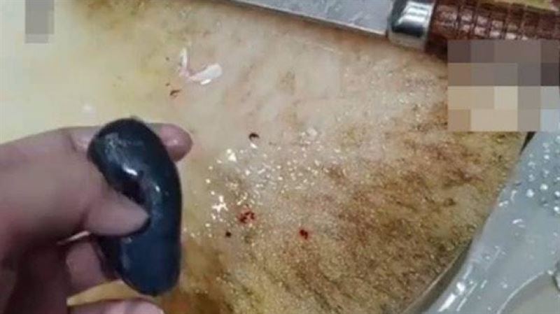 女生吞魚膽膽治頭痛　醫：比砒霜還毒