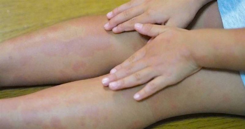 大陸7歲女童長紅疹，元凶是父親香港腳。圖僅示意，與本文無關。（示意圖／photoAC）
