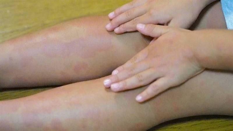 衣物混洗女童長紅疹　醫：嚴重恐毀容