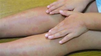 大陸7歲女童長紅疹，元凶是父親香港腳。圖僅示意，與本文無關。（示意圖／photoAC）