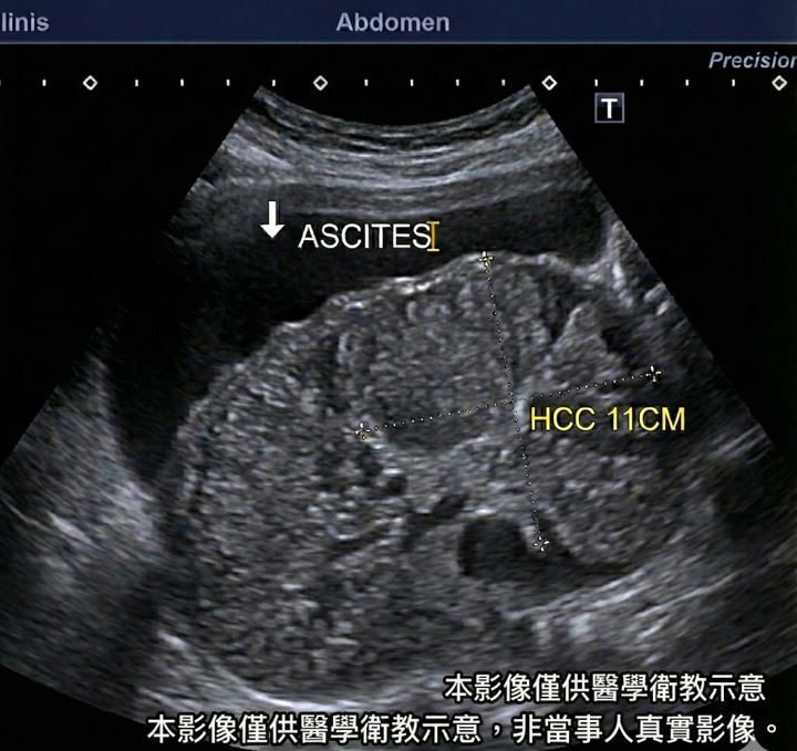 40歲男腹部脹大，以為僅是脹氣。（圖／翻攝自卓韋儒醫師｜內視鏡專科・肝膽胃腸臉書）