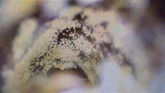 年輕女耳朵長香菇　醫揭1習慣害的：發黴