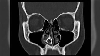 她「鼻水流10年」治不好！醫一挖：化石？