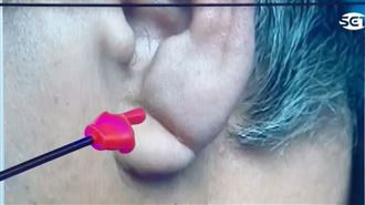 耳垂冒1條線是奪命符？醫揭高膽固醇3徵兆