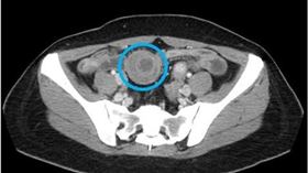 45歲女，小腸套疊，如望遠鏡，醫師揪出元兇，罕見「Vanek腫瘤」，切除(圖／澄清平等醫院)