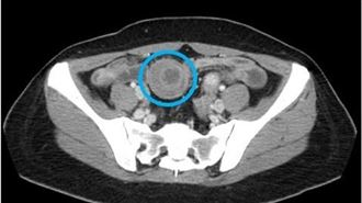 45歲女腹痛1個月　驚見小腸套疊如望遠鏡