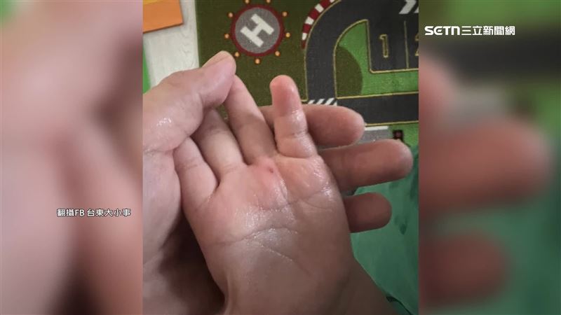 彈跳床鐵絲外露傷童　台東兒童公園惹議