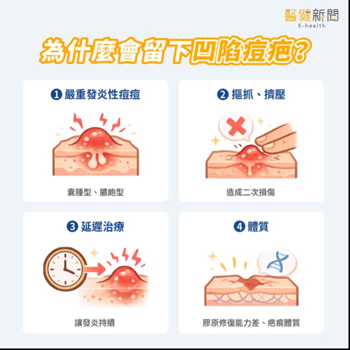 滿臉「痘」花好焦慮！為什麼會留下凹陷型痘疤？。（圖／醫健新聞網提供）