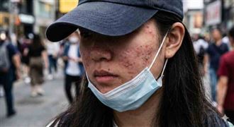 滿臉「痘」花好焦慮！醫提「4大」關鍵