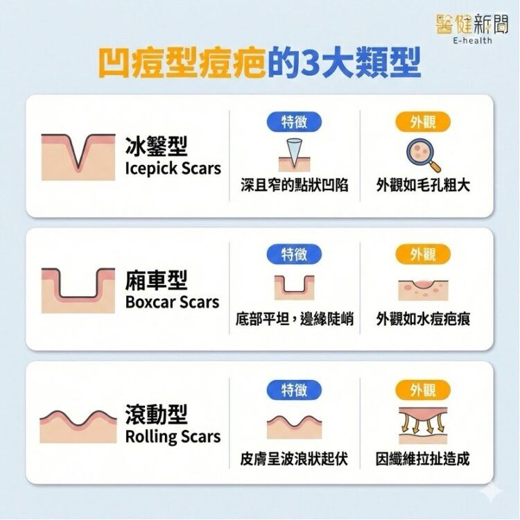 滿臉「痘」花好焦慮！凹陷型痘疤的3大類型。（圖／醫健新聞網提供）