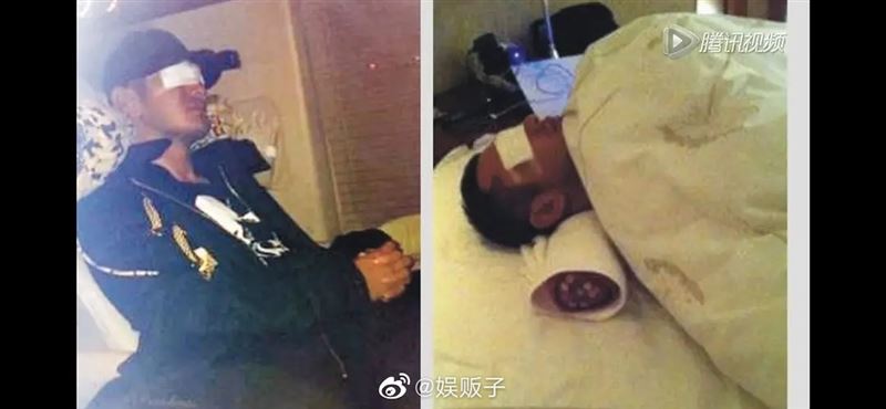 黃曉明傷好了之後組織增生，也留下不少後遺症。（圖／翻攝自微博）