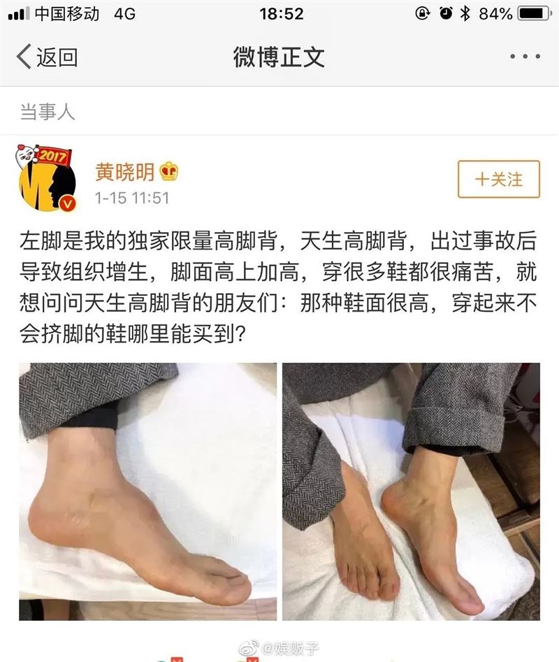 黃曉明傷好了之後組織增生，也留下不少後遺症。（圖／翻攝自微博）